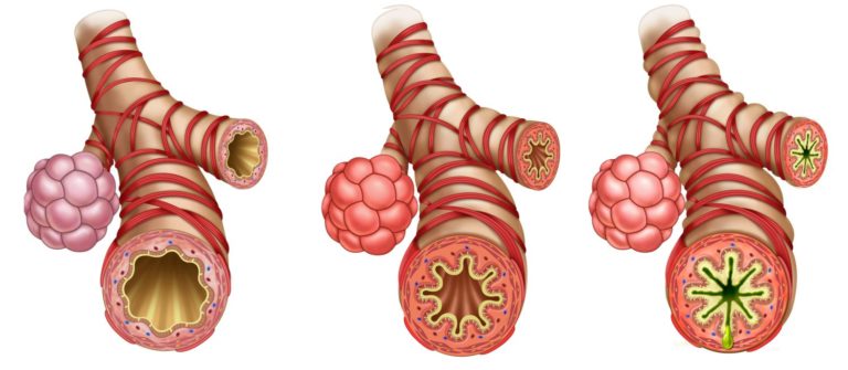 Ilustración que muestra tres porciones de bronquios y alvéolos, una sana y otra inflamada y la tercera con asma severo (el tracto respiratorio está totalmente obstruido por una reacción alérgica al moho)